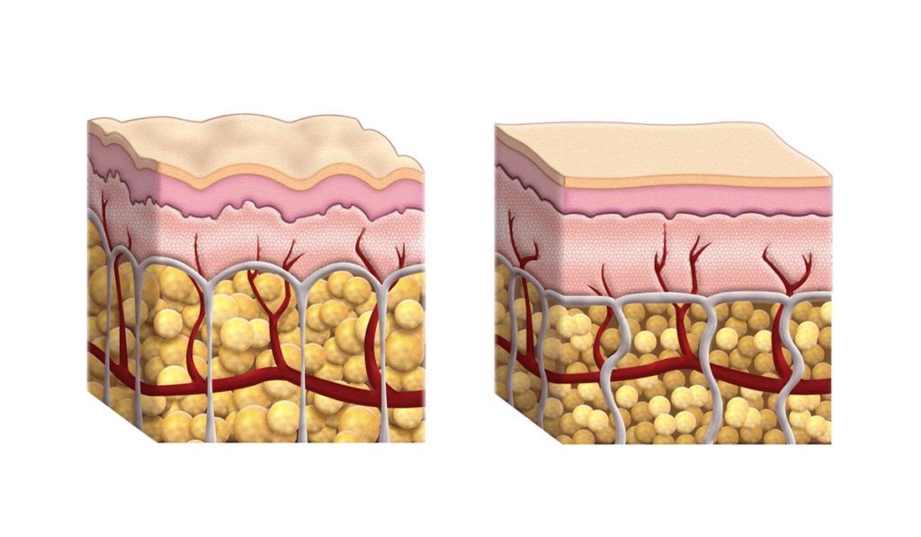 formazione della cellulite nella pelle